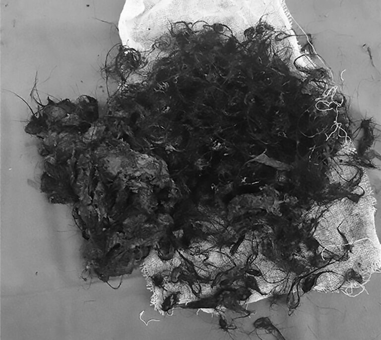 Read more about the article Giant Hair Balls Removed From 7yo Girls Tum In 12h Op
