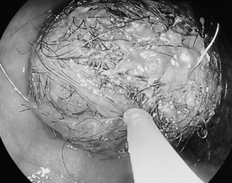 Read more about the article 8yo Girl Has Giant Hairball Removed From Stomach
