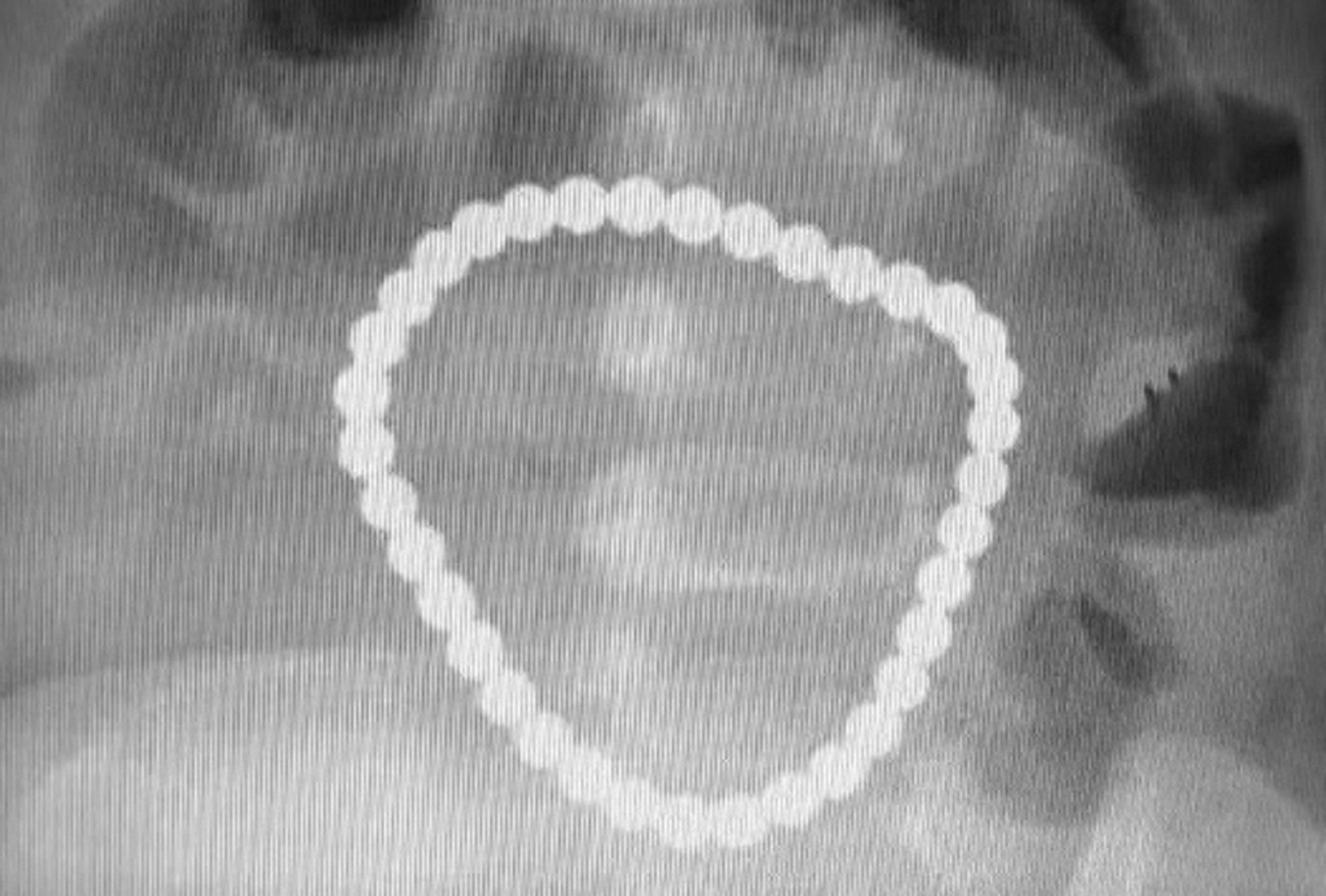 Read more about the article Tot Eats 36 Magnetic Balls Puncturing Intestine