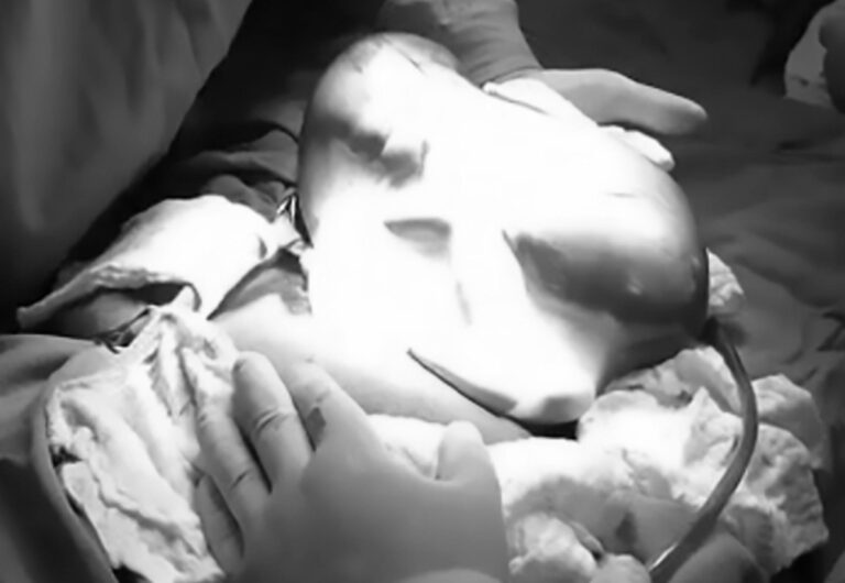 Read more about the article Footage Of Baby Born In Amniotic Sac In Rare Birth