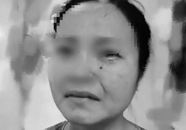 Read more about the article COVID-19 Man Bites Chinese Nurse On Face