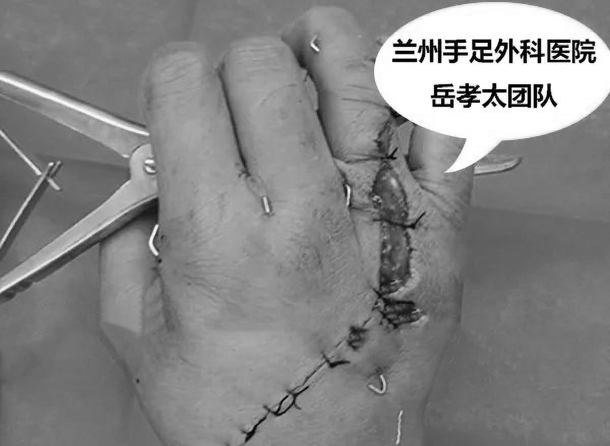 Read more about the article Doc Sews Hand Back Together After Builder Saws It Open