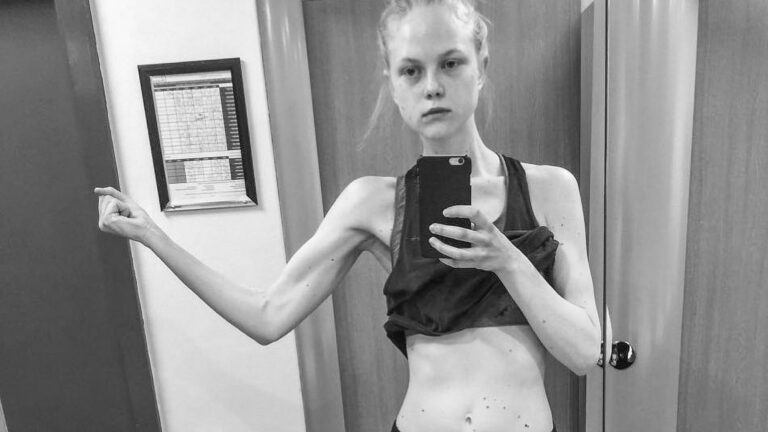 Read more about the article Top Model Reveals How Industry Created Anorexic Drug Hell