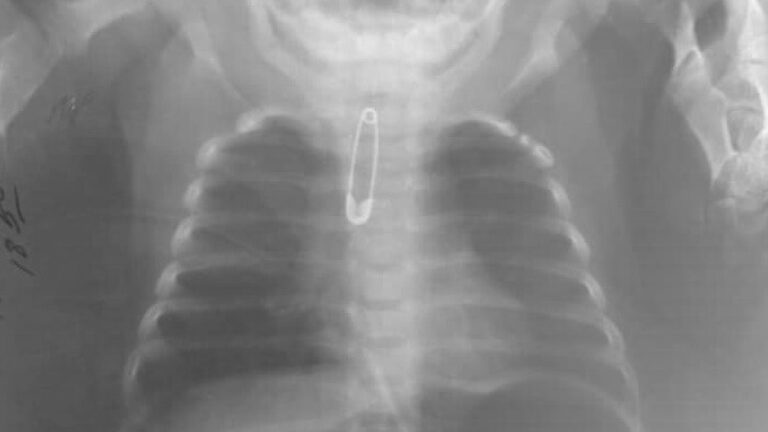 Read more about the article Safety Pin Removed From Three Month Old Babys Throat