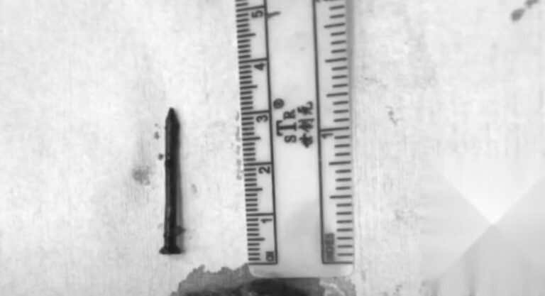 Read more about the article Rusty Nail Removed From Chinese Carpenters Lung After Swallowing It 2 Years Before