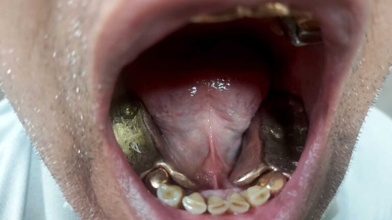 Read more about the article Customs Foil Plan To Smuggle Gold Melted Down As Dentures