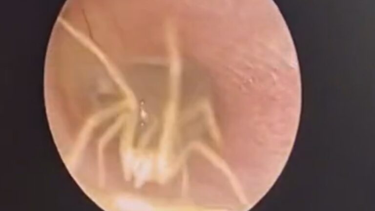Read more about the article Terrifying Moment Spider In Womans Ear Suddenly Scurries Towards Doctors Miniature Camera