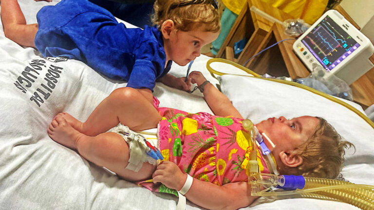 Read more about the article Formerly Conjoined Twins Given Zero Chance Of Survival Reunited After Leaving ICU Aged 1