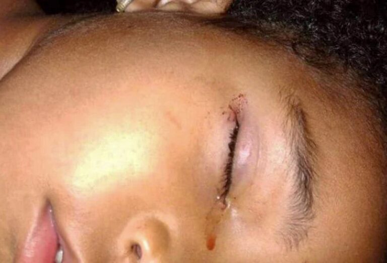 Read more about the article Rat Sneaks Into Family Home And Bites Eye Of Poor Girl, 3, While She Slept