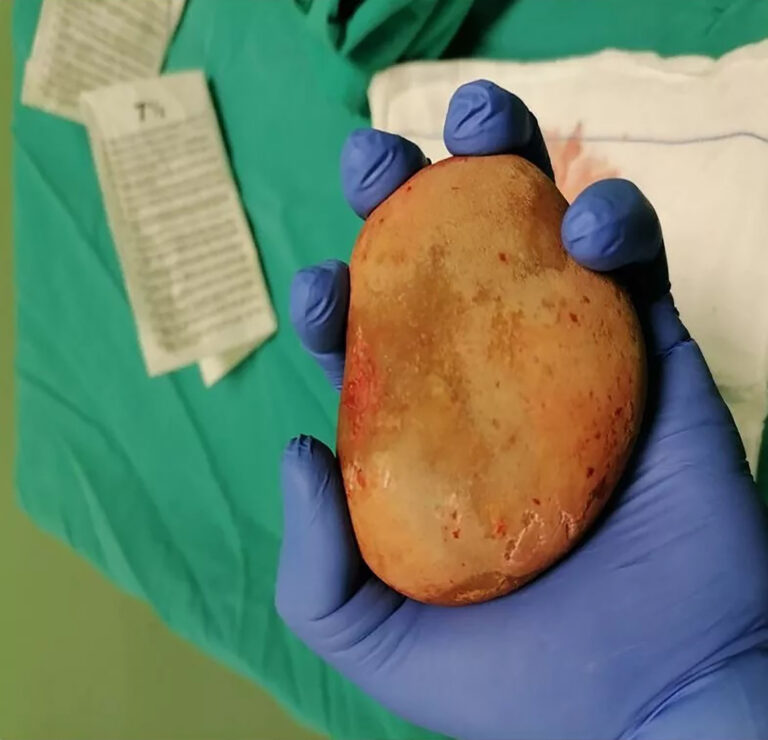 Read more about the article Huge Bladder Stone That Looks Like A Potato Has Been Removed By Doctors