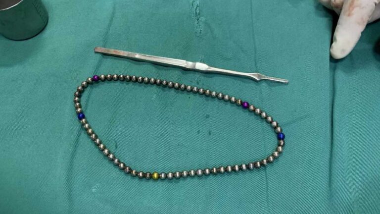 Read more about the article Surgeons Remove 74 Magnetic Beads From Boy’s Bladder