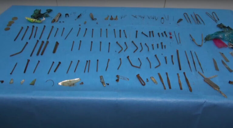 Read more about the article Astonished Surgeons Find 158 Metal Objects In Woman’s Stomach