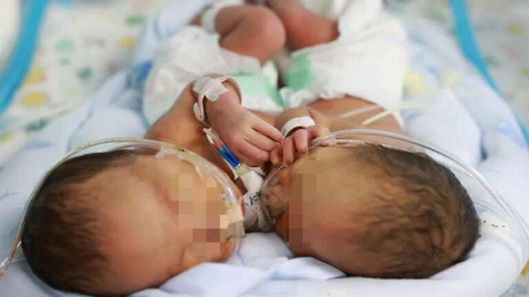 Read more about the article Conjoined Twins Separated After Miracle Op