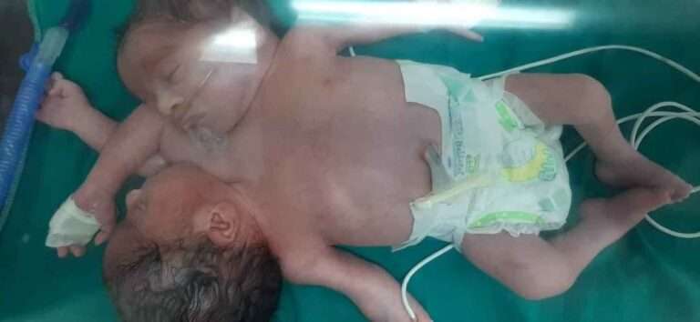 Read more about the article Mum Gives Birth To Conjoined Twins