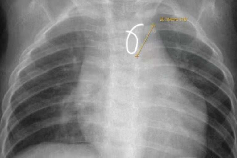 Read more about the article X-Ray Footage Reveals Tot Swallowed Necklace