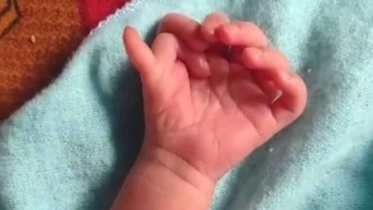 Read more about the article Indian Baby With 26 Fingers And Toes Is Rebirth Of Goddess, Say Parents