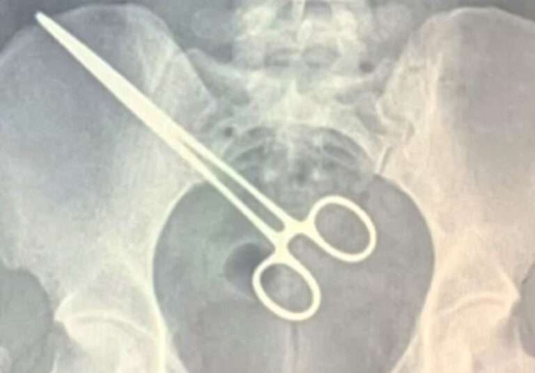 Read more about the article Jail Metal Detector Finds Tweezers Left Inside Woman By Surgeons