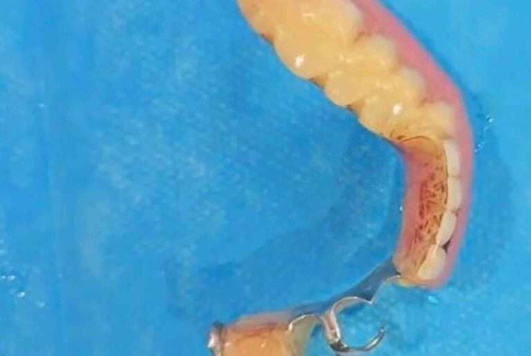 Read more about the article Elderly Man’s Dentures Lodged In Stomach After Swallowing Them While Eating Sweet Potatoes