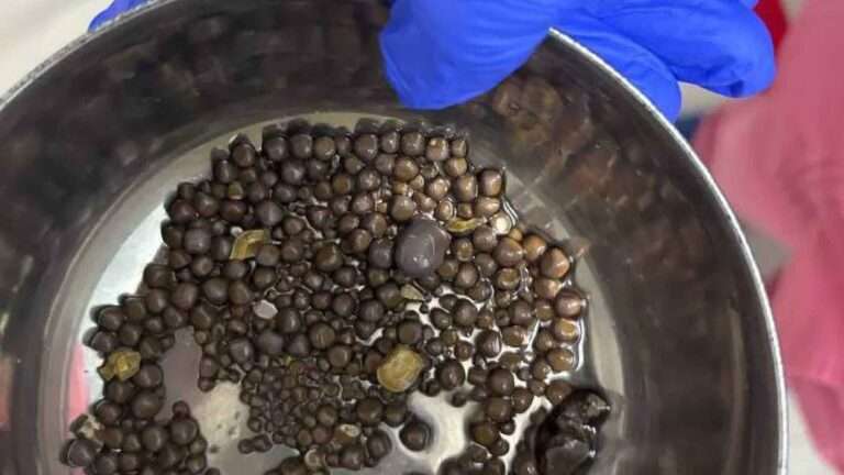 Read more about the article Surgeons Remove 418 Kidney Stones From 60-Year-Old Patient