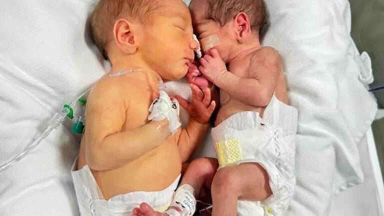 Read more about the article Twins Babies Surprise Medics Being Born At Different Sizes