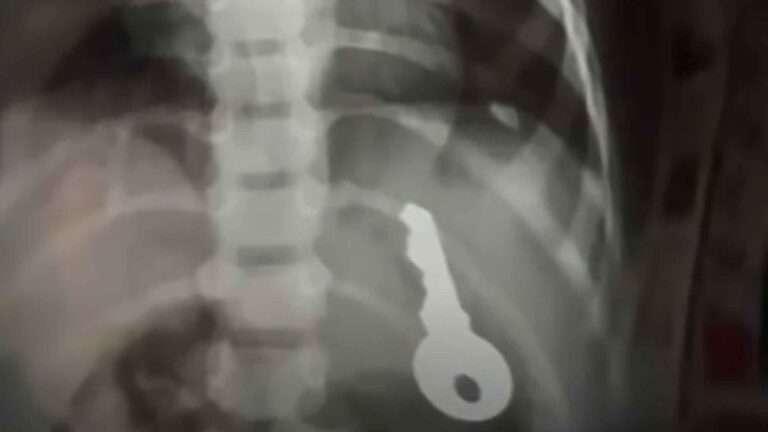 Read more about the article Docs Save Boy, 2, Who Swallowed Key That Slid Into His Stomach