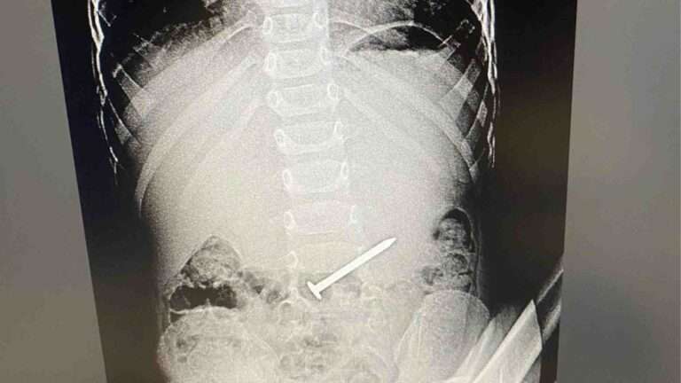 Read more about the article Surgeons Remove Massive Nail Swallowed By Three-Year-Old